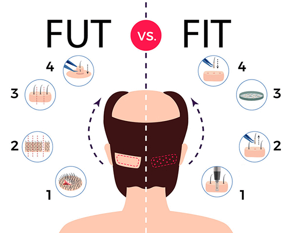 عکس گرافیکی-تفاوت دو روش کاشت FUT و FIT